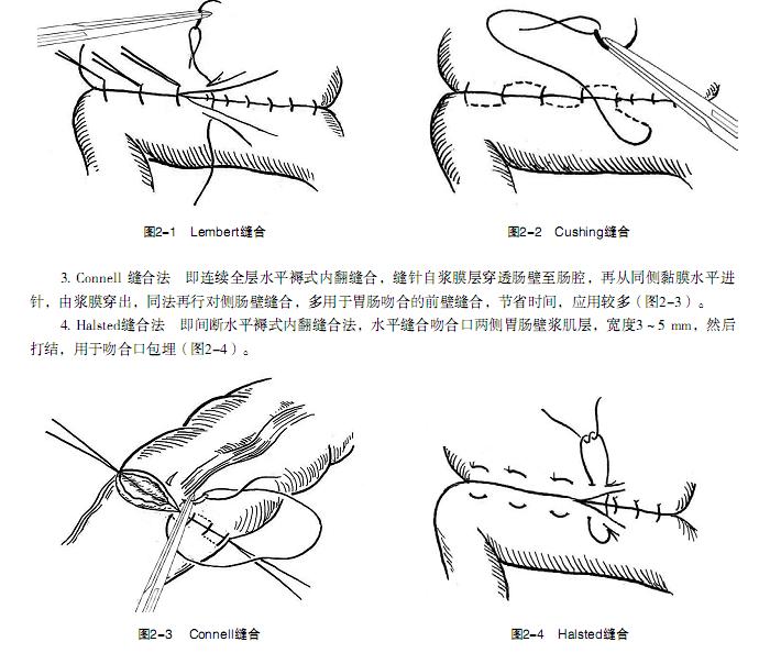 胃肠手术策略与操作图解