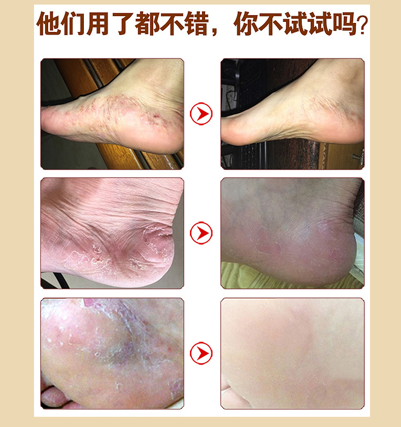 【无效可退】日本马油足膏清化脚气脚痒脚脱皮脚汗脚丫不反复泡脚防