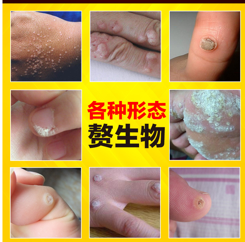 雅美肤 特效草本克疣霜u博士滴优去除手足疣丝状瘊子疣扁平寻常脖子
