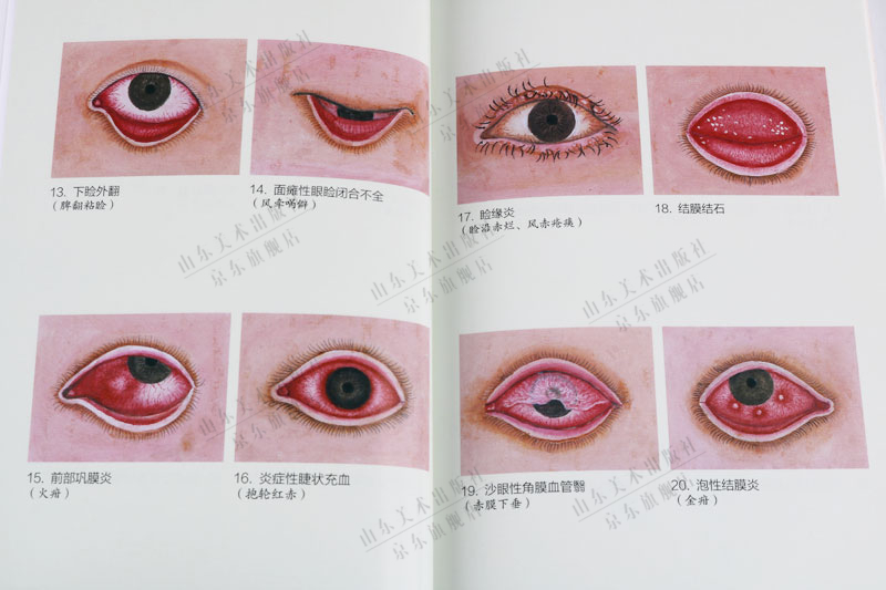 眼病治疗绝招 放血疗法 中国中医药出版 正版书籍