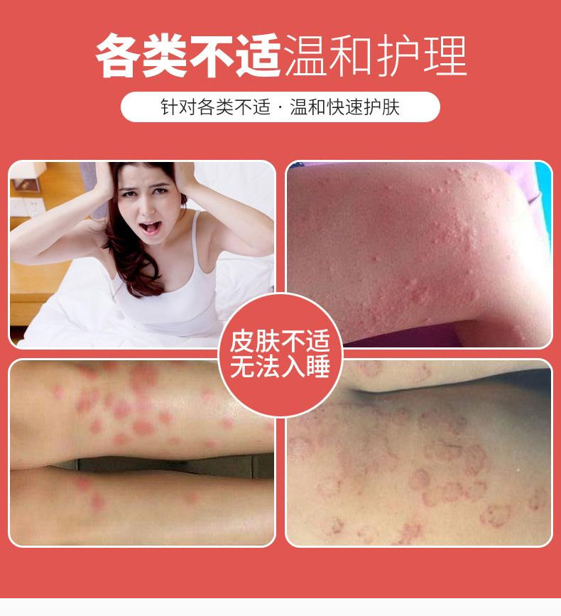 雅美肤 癣王肤专家大腿内侧瘙痒股癣膏汗斑净牛皮肤癣痒灵皮肤外用肤