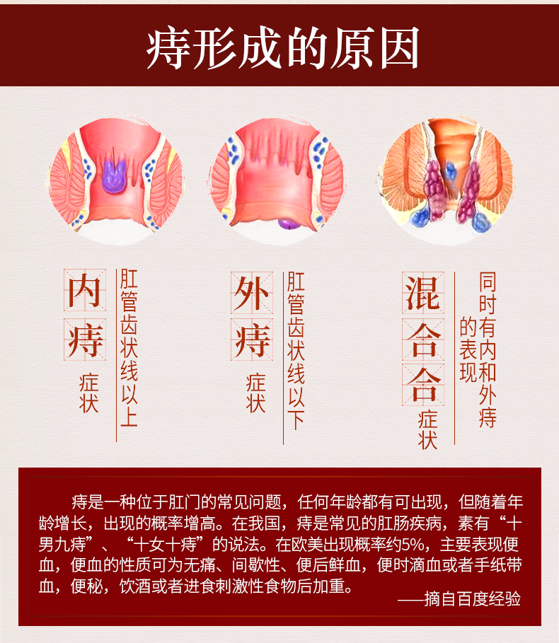 修正痔疮膏去肉球痔疮膏内痔外痔混合痔肛裂脓肿肛周抑菌乳膏壳聚糖