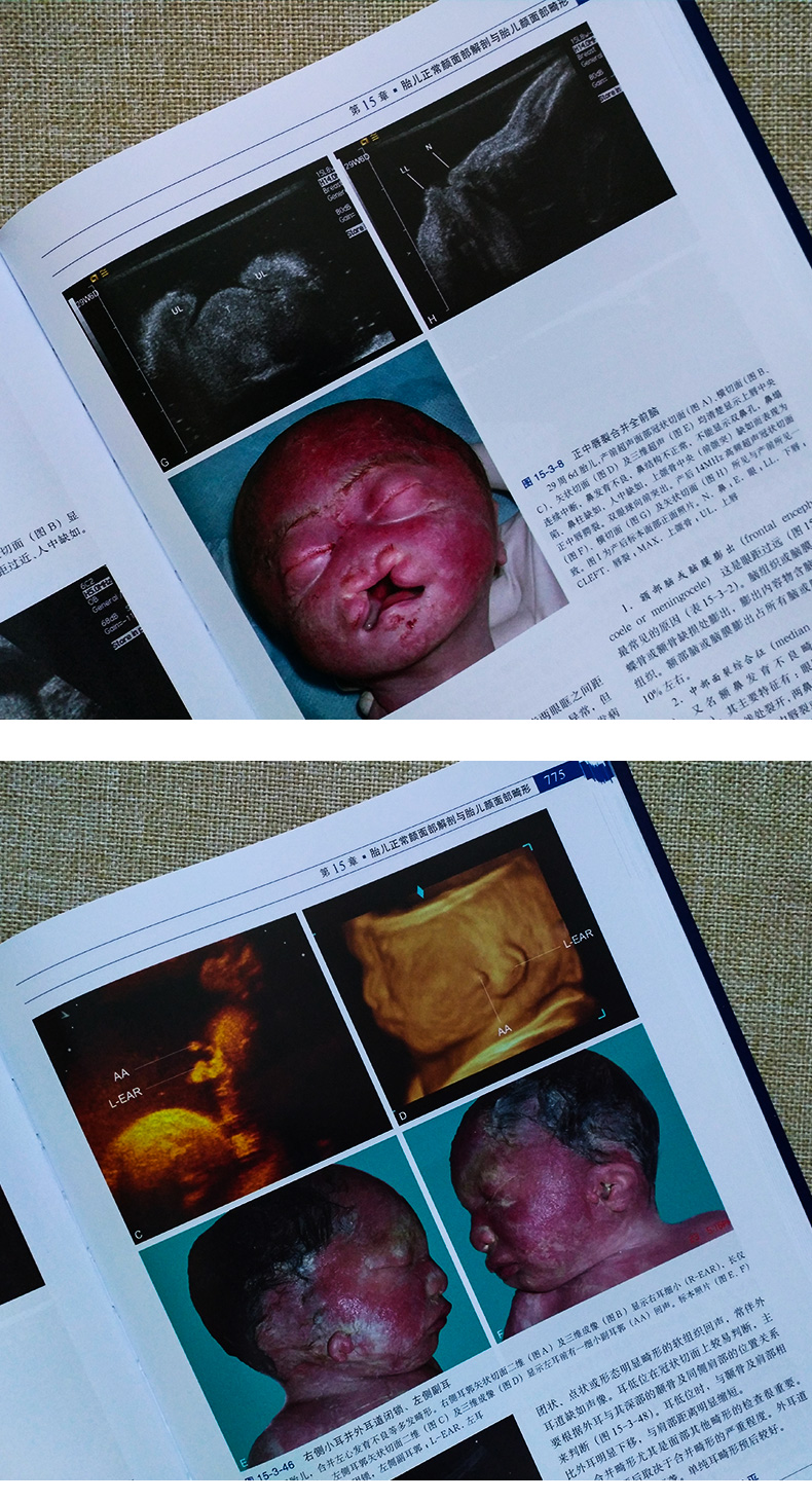 胎儿畸形产前超声诊断学 第二版 李胜利 产前超声检查 胎儿先天性疾病