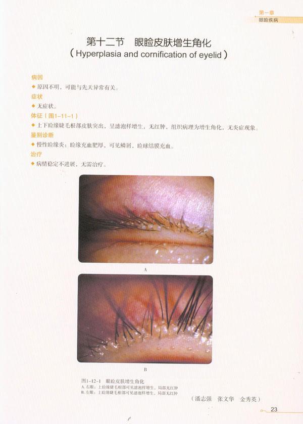 目录  第一章 眼睑疾病 第一节 睑缘炎 第二节 睑板腺功能障碍 第三