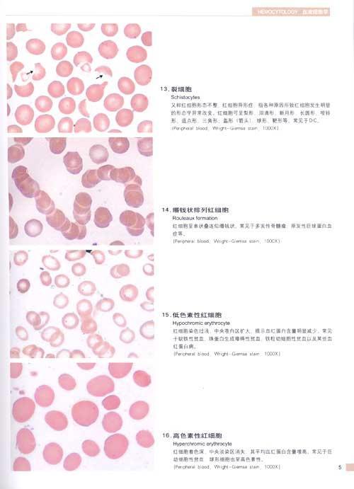 嗜多色性红细胞 11.泪滴形红