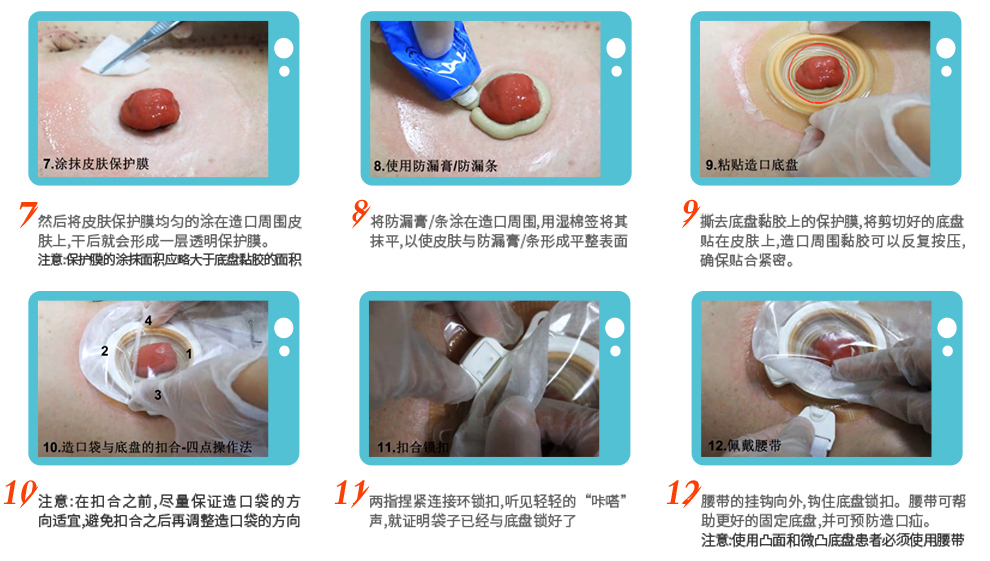 康乐保(coloplast) 康乐保造口袋二件式1759 特舒尿路造瘘造口袋 60mm