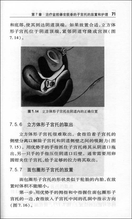 第1章子宫托用于治疗子宫和阴道脱垂的历史