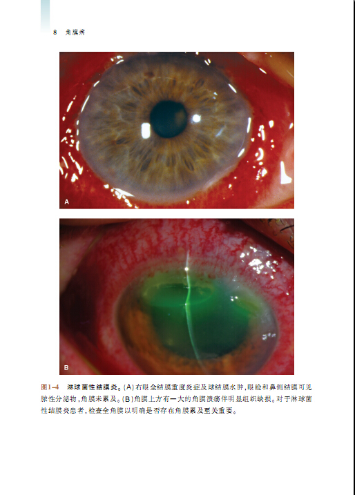 睑缘炎和睑板腺炎(1) 睑板腺囊肿(内睑腺炎,麦粒肿)(3) 细菌性结膜炎