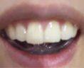 贝斯尼 Besni 【三阶段矫正器含紫外线消毒盒】5D牙齿矫正器牙套矫正器成人防磨牙保持器正畸纠正龅牙地包 实拍图