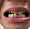 雅舒美牙齿矫正器成人隐形透明牙套定制龅牙矫正牙缝矫正器 上牙1个 实拍图