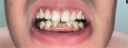 雅舒美牙齿矫正器成人隐形透明牙套定制龅牙矫正牙缝矫正器 上牙1个 实拍图