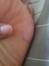 修正皮肤抑菌液清茧软化角质猴子淡化脚底老茧手上足部修护脚皮层 修正皮肤抑菌液10ml 实拍图