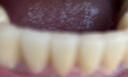 DALEK 戴立克二氧化锆全瓷牙烤瓷牙套牙冠牙齿假牙美白牙齿 3M蛀牙补牙超声波洗牙洁牙全瓷超薄贴面 爱尔创全瓷牙 实拍图