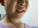 贝斯尼儿童牙齿矫正夜间保持器牙套男女通用硅胶防磨纠正龅牙地包天反颔 一阶段+二阶段（儿童款） 实拍图