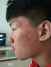 仁和匠心男士祛痘洗面奶氨基酸护肤品青少年青春期清洁改善痘痘清洁肌肤 植萃祛痘控油洗面奶1瓶/150g 实拍图