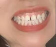 牙龈萎缩修复牙周炎牙龈肿痛出血牙根萎缩外露发黑牙齿松动牙根痛治牙龈炎消炎消肿止痛药甲硝唑口腔粘贴片 【牙龈萎缩外露】3盒一疗程 实拍图