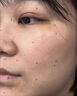 正精研康去痣点痣膏美容院专用无痕无痛脸部祛痣儿童可用正品雀斑平瘊黑痣 3盒装【买二送一】 实拍图