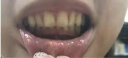 ZICCO牙齿矫正器隐形牙套矫正器儿童成人牙齿矫正防磨牙龅牙不齐地包天 定制1期上下(3期送动画) 实拍图