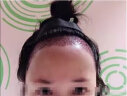 碧莲盛植发男女舒适化植发 发际线种植适用美人尖微调鬓角/颞角修补 全国通用（包含医师费 无隐形消费） 不剃发1000单位 实拍图