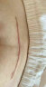 医用硅凝胶硅酮疤痕贴儿童面部甲状腺手术后剖腹产隐形防晒祛辅助疤去疤专用修复点痣烫伤增生凸起去除疙瘩 疤痕贴 4*15cm1片/盒  【可裁剪使用】 晒单实拍图