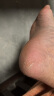 丽芙尿素乳膏20%15g/盒尿素软膏尿素霜医用尿素乳膏手脚干裂皮肤干燥手足皲裂脚后跟干裂膏角化型脚气 晒单实拍图