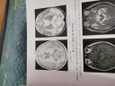 影像鉴别诊断一目了然系列--MRI鉴别诊断一点通（第三版） 实拍图