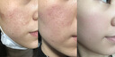 精灵栖木寡肽冻干粉修复红血丝点斑痣后泛红修护敏肌增厚角质维稳多肽舒缓 多肽修护舒缓冻干粉 1盒（5支5ml+5支200mg） 实拍图