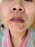 同仁堂祛痘印修复淡化痘印痘坑修复凹洞去痘坑去痘疤去痘痘和痘印粉刺 一盒装【拍二发三】 实拍图