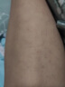 奇力康鸡皮肤疙瘩毛囊角化症专用非药去角质疙瘩大腿手臂去除神器特傚 專治鸡皮肤 一盒（内含5小支/一抹见校） 实拍图