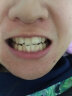 爱牙牙牙齿矫正器牙套矫正隐形牙套成人纠正龅牙地包天保持器夜间磨牙套 D1 透明 实拍图
