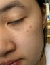 佰珍堂寡肽冻干粉精华原液祛痘印坑修复泛红紧致收缩毛孔补水美容男女士  ( 22支 )送同款发44支 实拍图