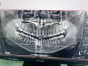京东健康甄选 3M树脂补牙  补牙洞牙缝蛀牙服务修复龋齿  缺牙 漏牙 渠道专享 晒单实拍图