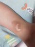 爱可欣儿童祛疤膏硅酮疤痕凝胶淡化修复脸部疤痕增生疤 15g一支（送疤痕贴） 晒单实拍图