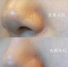 贝妮丝小气泡吸黑头仪去黑头粉刺仪器神器黑头清理神器电动面部脸部毛孔清洁器小气泡清洁仪器美容院家用 尊享款三档 补水仪+气泡水+6头+精华 实拍图