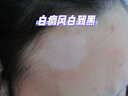 田哥白癜风遮盖液神器白斑皮肤病修复促黑色素生长白癜风膏药(非进口) (发货特效)308:一盒装【限时特价】 白癜风外用黑色素生长快速消白斑皮肤病专用搭补骨脂 实拍图