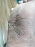 润芷堂脚气泡脚【泡喷抹】脚臭脚汗脱皮水泡型脚痒汗臭脚出汗丫脚气喷雾 轻度中度脚气选择【1套】 实拍图
