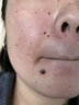 点痣后修复膏防疤痕点痣祛i疤痕凹坑去红印专用修复脸部激光术后点斑专用生长因子凝胶液 单盒装(已售99+) 实拍图
