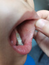 贝斯尼 Besni儿童牙齿矫正器牙套男女夜间保持器防磨牙纠正保持器套装 晒单实拍图
