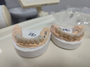 爱本丘牙冠全瓷牙套威兰德3M拉瓦泽康二氧化锆补镶牙烤瓷牙爱尔创全瓷牙 威兰德全瓷牙 实拍图