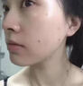正精研康去痣点痣膏美容院专用无痕无痛脸部祛痣儿童可用正品雀斑平瘊黑痣 3盒装【买二送一】 实拍图