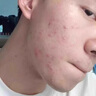 韩纪祛痘膏 青春痘痤疮洗面奶 控油消除精华液青少年痘印痘坑痘痘淡化 三件套 实拍图
