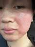 奢泉美冷敷贴微整术后修护红肿花敏晒后过敏瘙痒肌肤敏感肌肤院线产品女 奢泉美玻尿酸水光补水保湿面膜 二盒【10片】 实拍图