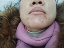 [豆克]复方珍珠暗疮片 0.3g*36片 5盒装 祛痘去痘痘消炎痤疮专用闭口粉刺青春痘祛痘痤疮专用药脸上去痘痘的药清热解毒下巴 祛痘消炎 下巴脓疱疮 实拍图