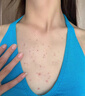 同仁堂后背痘痘药膏后背长痘痘毛囊炎专用前胸后背部脓包痤疮祛痘喷雾剂 一盒装【多买多送】发货特效快 实拍图