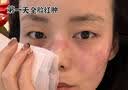 奢泉美冷敷贴微整术后修护红肿花敏晒后过敏瘙痒肌肤敏感肌肤院线产品女 奢泉美医用冷敷贴 一盒【5片】 实拍图