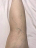 北同御贡静脉曲张冷敷凝胶蚯蚓腿专用膏药非贴下肢肿胀青筋凸起精索 1盒 实拍图