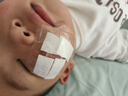 施美乐医用减张器张力贴皮肤减张贴儿童面部疤痕伤口甲状腺剖腹产术后 减张器 长17mm 1扣*6贴 【医院外科同款】 实拍图