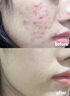 透真祛痘控油舒缓水乳层孔菌收缩毛孔补水保湿护肤品爽肤水乳液男女士 实拍图