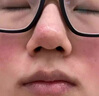 示博士酒糟鼻草莓鼻红肿玫瑰痤疮红鼻子专用去粉刺黑头红血丝螨虫修护软 五盒巩固装（重度型） 搭红鼻子酒糟鼻头红肿消炎产品用 实拍图