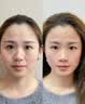 吖莘奕水光仪器纳米微晶微针导入脸部家用打美容院专用全套自动出液 耗材全家桶【拍一份即可】 实拍图